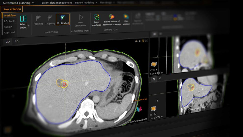 Raysearch Pro Liver Ablation | RaySearch Laboratories