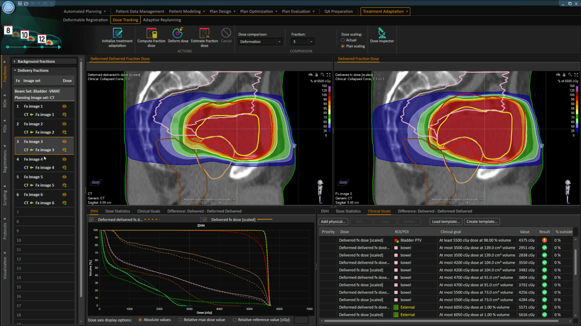 Treatment planning in RayStation