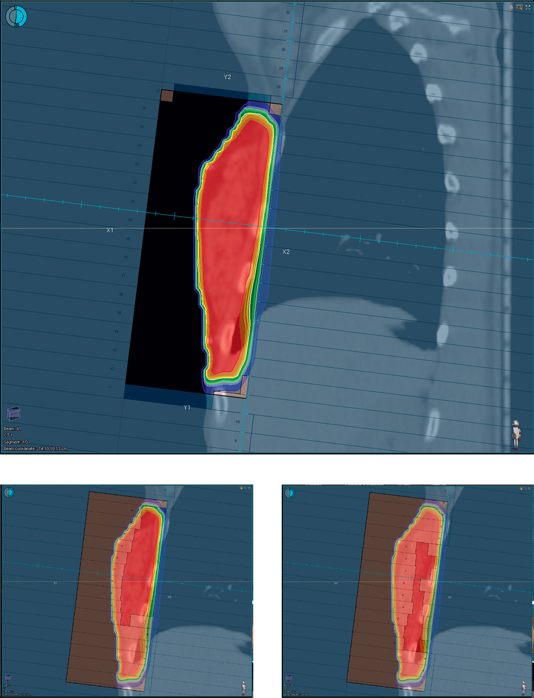 The segments of a tangential beam of a breast IMRT plan. Note the highly weighted open field