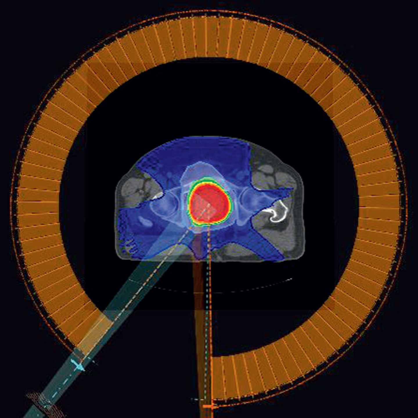 Ray Statio Constant dose rate VMAT in RayStation | RaySearch Laboratories