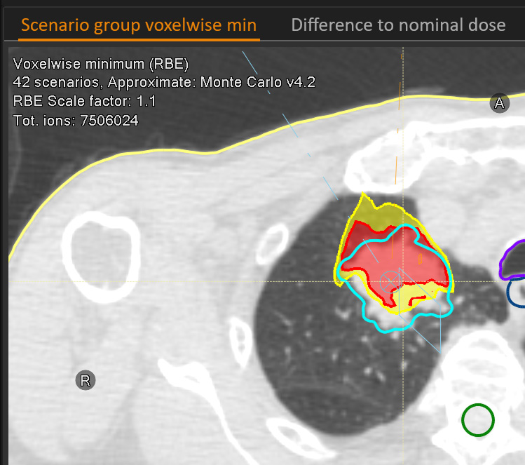 Voxelwise minimum dose distribution