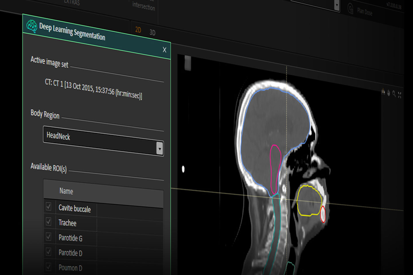 Ray Statio Patient Contouring and Plan Evaluation in RayStation | RaySearch ...