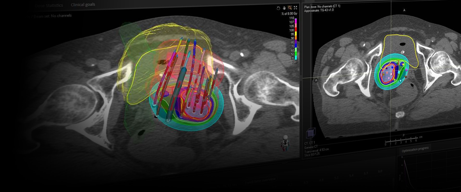 Brachytherapy in RayStation RaySearch Laboratories