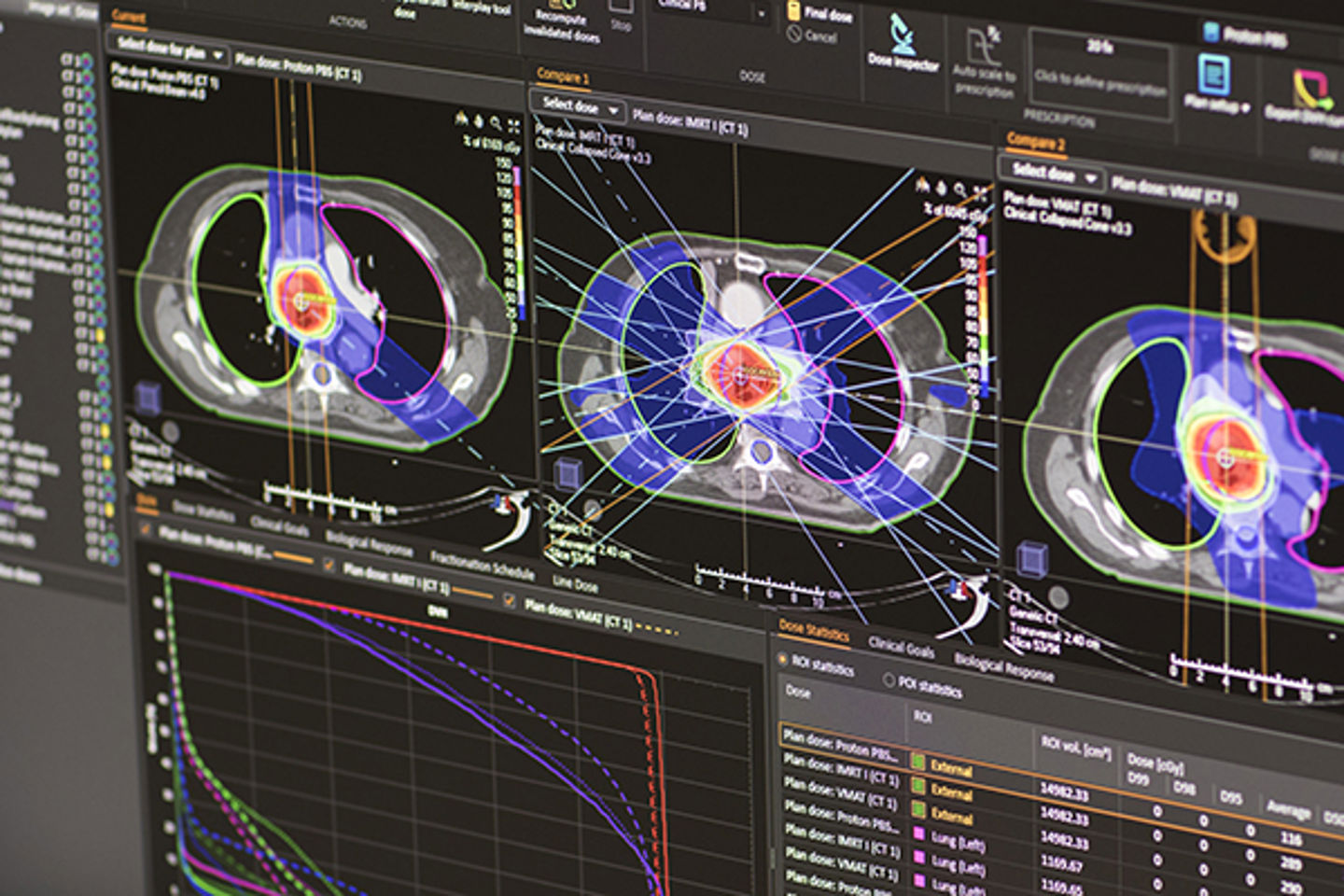 Ray Statio Patient Contouring and Plan Evaluation in RayStation | RaySearch ...